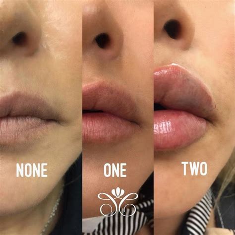 Whats Your Favorite Look None One Or Two 💉💉 Lips Juvederm