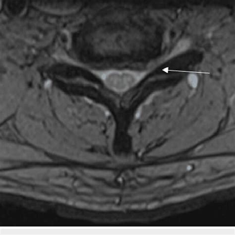 Preoperative T2 Weighted Mri Of The Cervical Spine Axial View