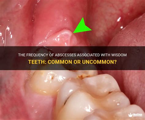 The Frequency Of Abscesses Associated With Wisdom Teeth Common Or