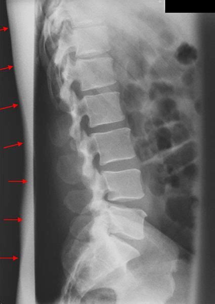 Normal Lumbosacral X Ray Six Lumbar Type Vertebrae Image