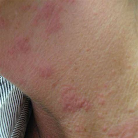 Pictures To Help You Identify Hives Vs Other Skin Rashes Hives