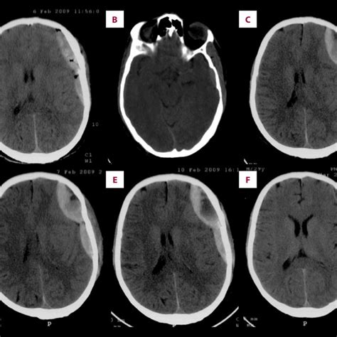 Head Ct Scan Reveals An Epidural Hematoma On Left Fronto Temporal