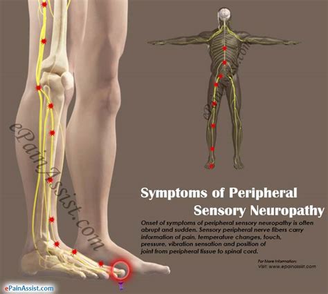 Symptoms And Causes Of Peripheral Sensory Neuropathy