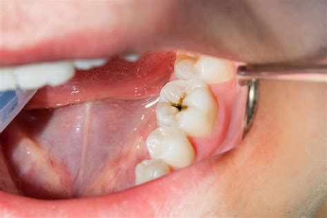 Close Up Of A Human Rotten Carious Tooth At The Treatment Stage In A