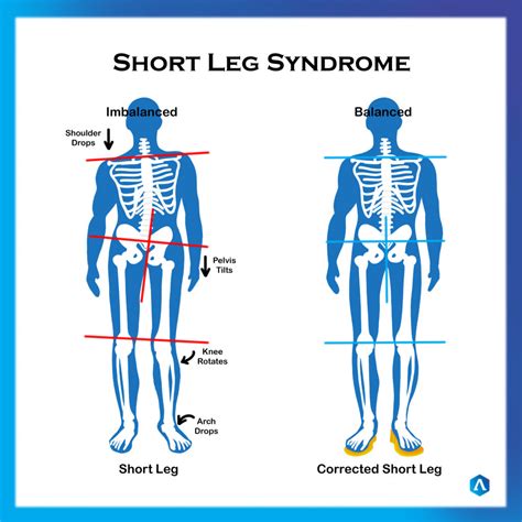 Can A Shorter Leg Cause Knee Pain