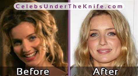 Annabelle Walliss Nose Job The Surgery Rumors Are True