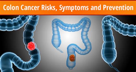How To Prevent Colon Cancer Risks Symptoms And Prevention