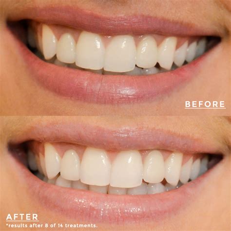 Sensitive Teeth After Using Crest Whitening Strips Teethwalls