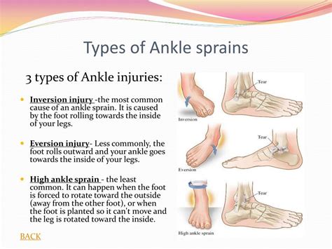 Different Types Of Ankle Sprains