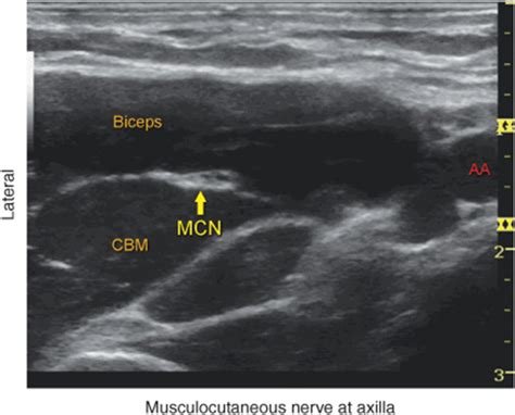 Ultrasound Guided Axillary Brachial Plexus Block Hadzics Peripheral