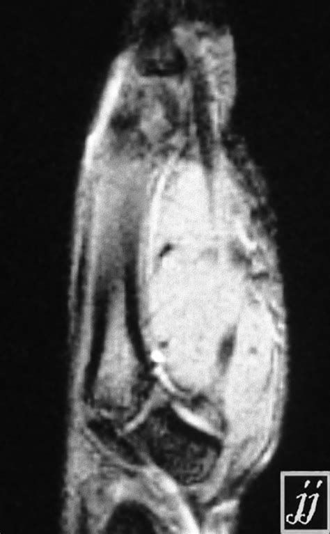 Ganglion Cyst Around Flexor Tendon Hand Sagittal T2 Radiopaedia