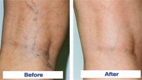 Here Is How To Make A Homemade Paste To Treat Your Varicose Veins