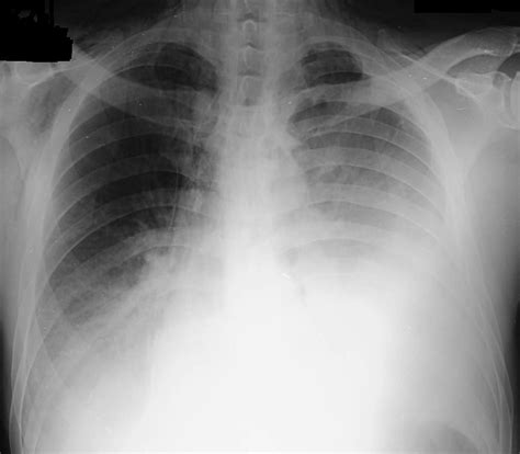 Check spelling or type a new query. Apical Pleural Thickening With Fibrosis