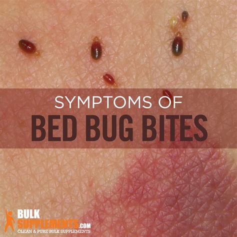 Bed Bug Bite On Leg