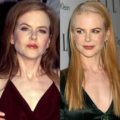 Nicole Kidman Before And After Plastic Surgery Pictures