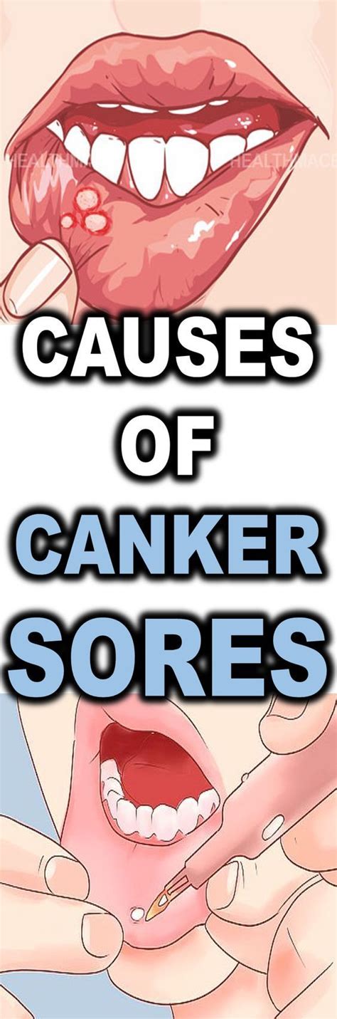 Causes Of Canker Sores Howsite Canker Sore Canker Sore Causes Cankers