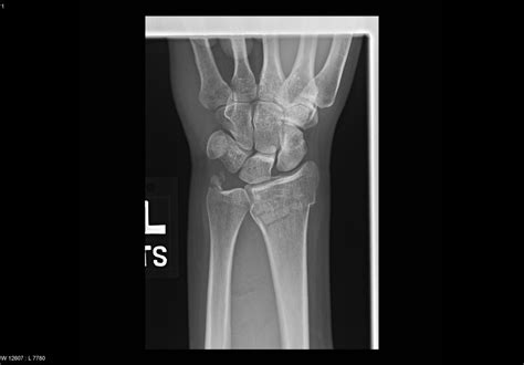 Fracture Of Distal Ulna Xray Radrounds Radiology Network