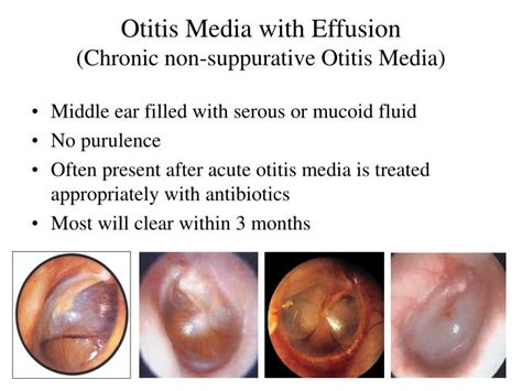 otitis media with effusion otitis media with effusion secretory otitis media when patients