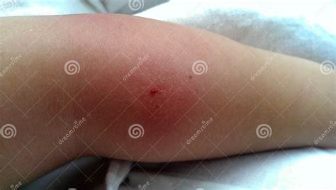 Infected Forearm From Mosquito Bite Stock Photo Image Of Redness