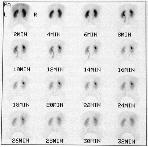 Factors Affecting The Hepatobiliary Excretion Of 99mtc Mag3 Its Clinical Significance In