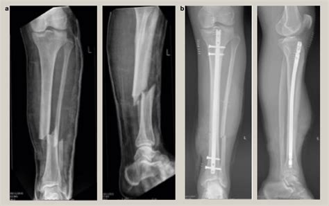 Open Tibial Fractures Orthopaedics And Trauma