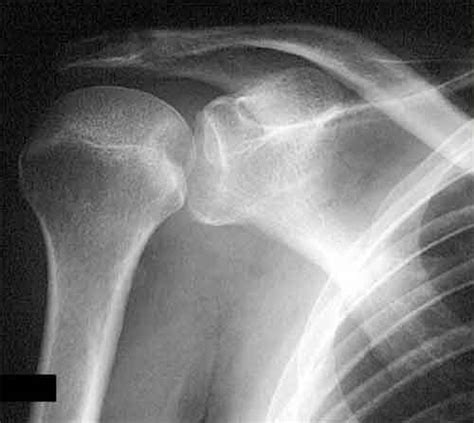 Posterior Shoulder Dislocation