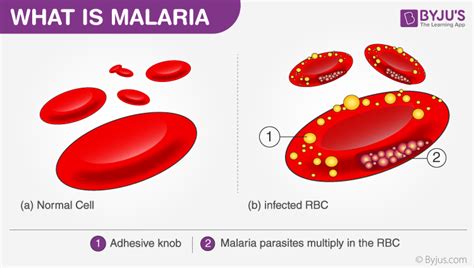 Malaria Causes Symptoms Prevention And Life Cycle Of Parasite