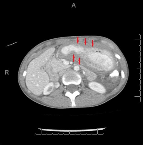 Cureus Rare Presentation Of A Rare Disease Signet Ring Cell Gastric