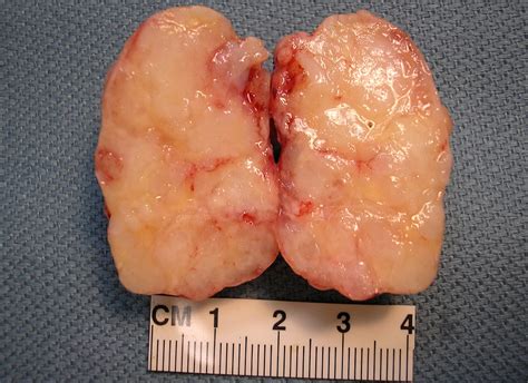 Qiaos Pathology Pleomorphic Adenoma Mixed Tumor Flickr