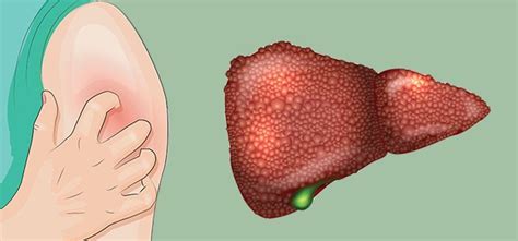 Bruise Easily Itchy Skin 5 Signs You Have Liver Damage Without Even
