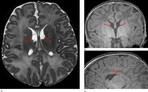 Incidental Findings On Brain Mr Imaging Of Asymptomatic Term Neonates