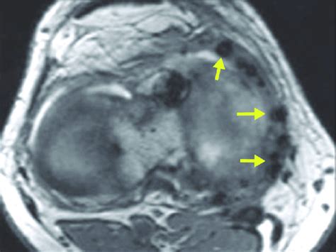 Axial T1 Weighted Fast Spin Echo Mr Image Of A Medial Meniscal