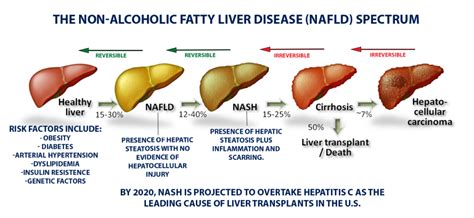 Fatty Liver Disease Texas Liver Institute