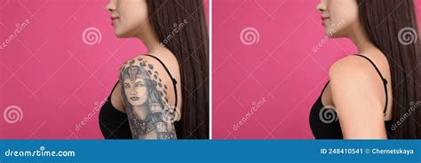 Aggregate More Than 71 Tattoo Removal Design Best Thtantai2