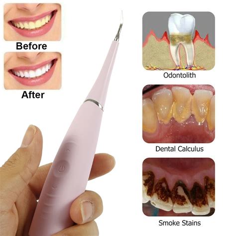 Although you might not think about your dental plaque is a sticky, soft film that over time can build up on your teeth due to microscopic pay very close attention to your back teeth, gum line, and other areas that are hard to reach. Electric Tooth Plaque Removal Calculus Plaque Removal Tool ...