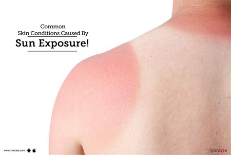 Common Skin Conditions Caused By Sun Exposure By Dr Ramesh Gosavi Lybrate