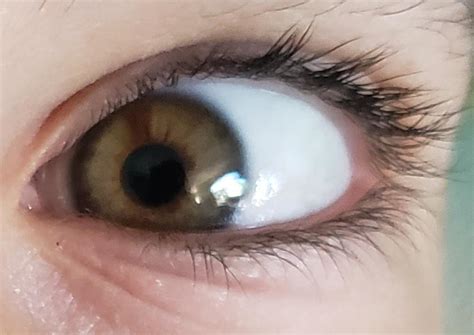 Sectoral Heterochromia Eyes
