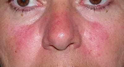 Da eine allergie an den augen, eine schwellung oder rötung, oftmals durch pollen ausgelöst werden, treten allergische reaktionen am auge häufig im frühling und im sommer in erscheinung. Rote Flecken auf Gesicht schält und juckt: was zu tun ist?