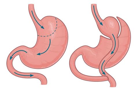 Gastric Bypass Tops Banding For T2d Remission Medpage Today