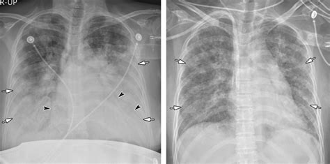 Người thầy thuốc phải hướng đến nguyên nhân và triệu chứng phù phổi khi điều trị bệnh nhân. Đặc điểm hình ảnh Xquang viêm phổi do CORONA VIRUS