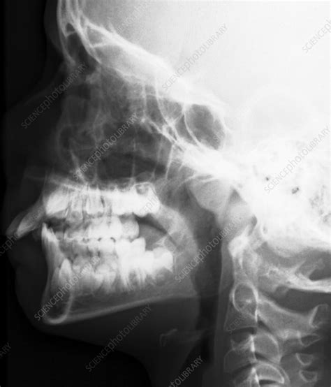 Adenoid Hypertrophy In A Child X Ray Stock Image C0132198