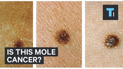 What Skin Cancer Moles Look Like