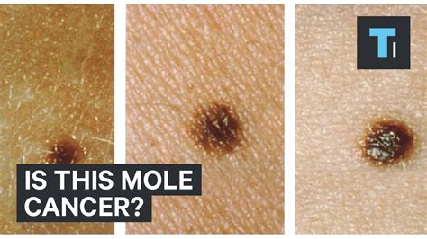 We did not find results for: Is this mole cancer? - YouTube