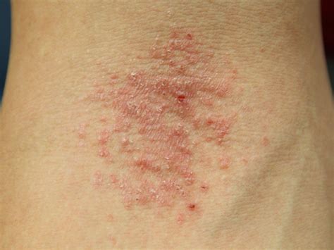 Atopic Dermatitis Cause Pictures Photos
