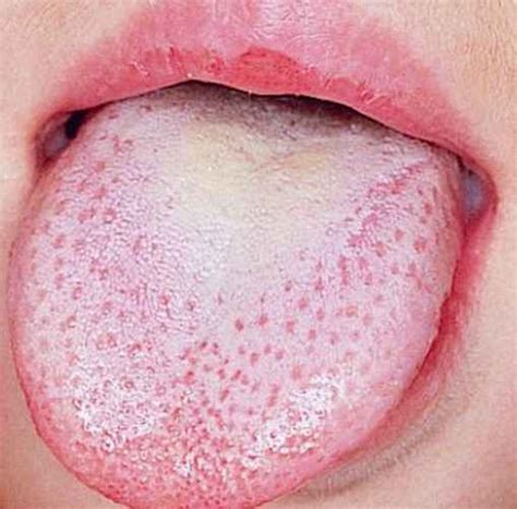 Bumps On The Tongue 9 Common Causes Pictures Treatment