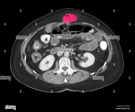 Computed Tomography Ct Scan Of Abdomenpelvis Axial View Showing A Images