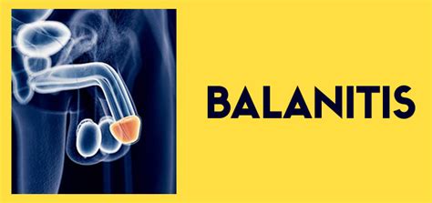 What Is Treatment For Balanitis