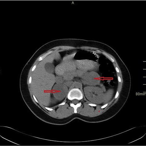 Ct Abdomen Pre Iv Contrast Showing Bilateral Adrenal Masses Download