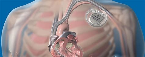 Implantable Cardioverter Defibrillator Icd ⋆ Hi Sky ⋆ ⋆