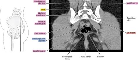 CT Of The Male Pelvis Radiology Key